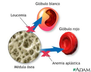 Tipos de anemia, aplásica