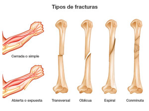 Tipos de fracturas en el cuerpo humano.